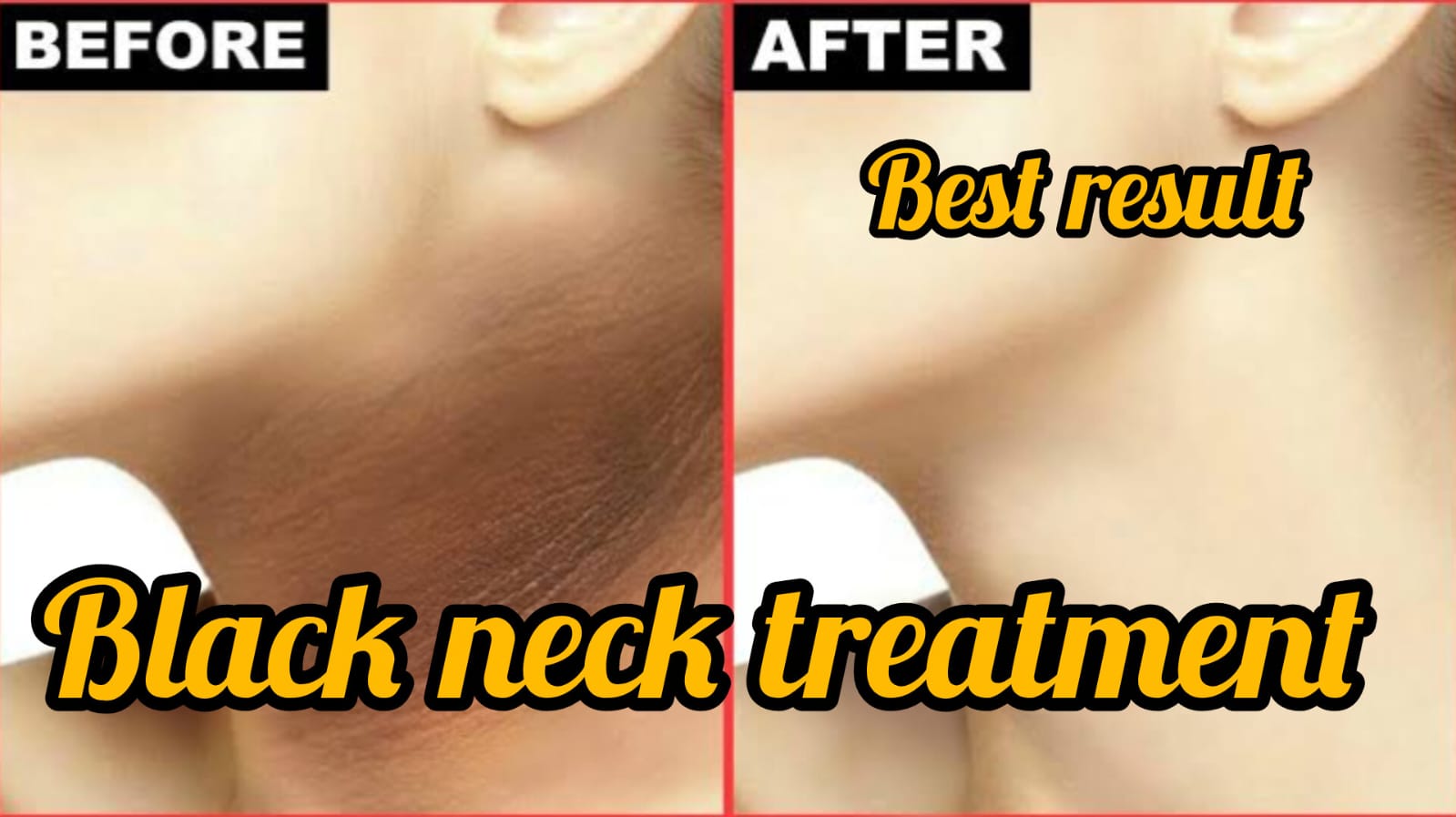 Before and after results of treating black neck with home remedies
