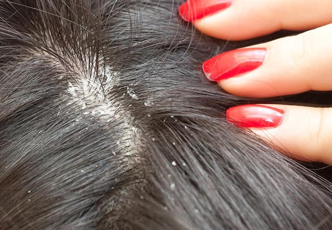 Natural ingredients like neem oil and comb used for removing lice from hair at home