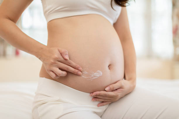 stretch Marks after pregnancy