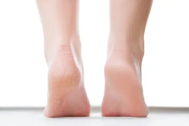 Cracked heels treatment with petroleum jelly - before and after results showing smooth healthy skin