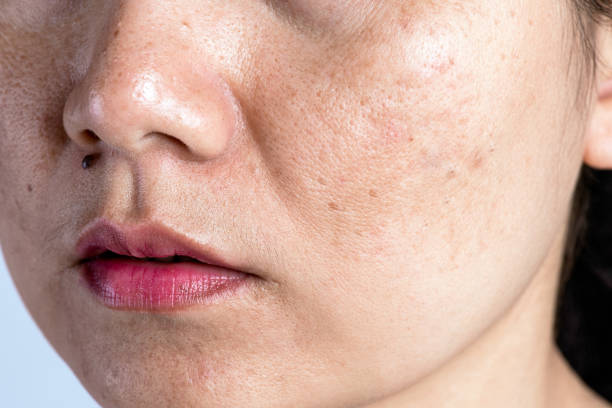Young woman with greasy skin, oily skin on her face.