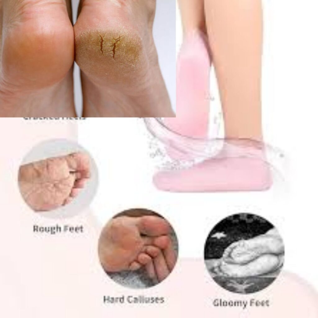 Petroleum jelly for cracked heels